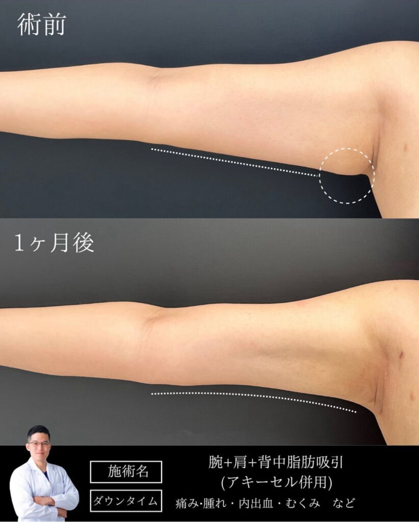 勘定医師の二の腕の脂肪吸引の症例写真