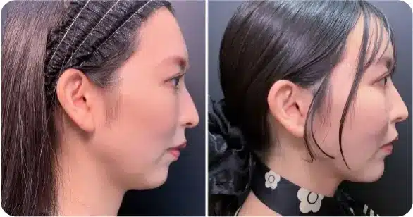 小顔整形
