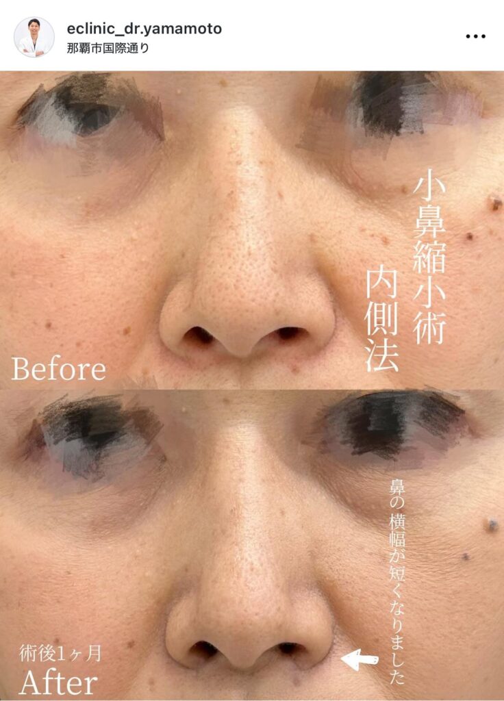 山本医師の小鼻縮小の内側法の症例写真