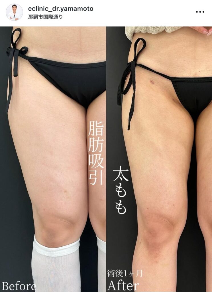 山本医師の太腿の脂肪吸引の症例写真