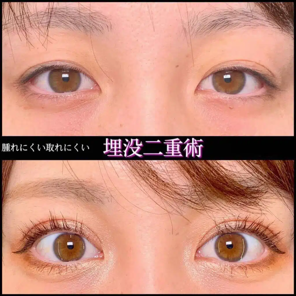 腫れにくい取れにくい 埋没二重術 那覇