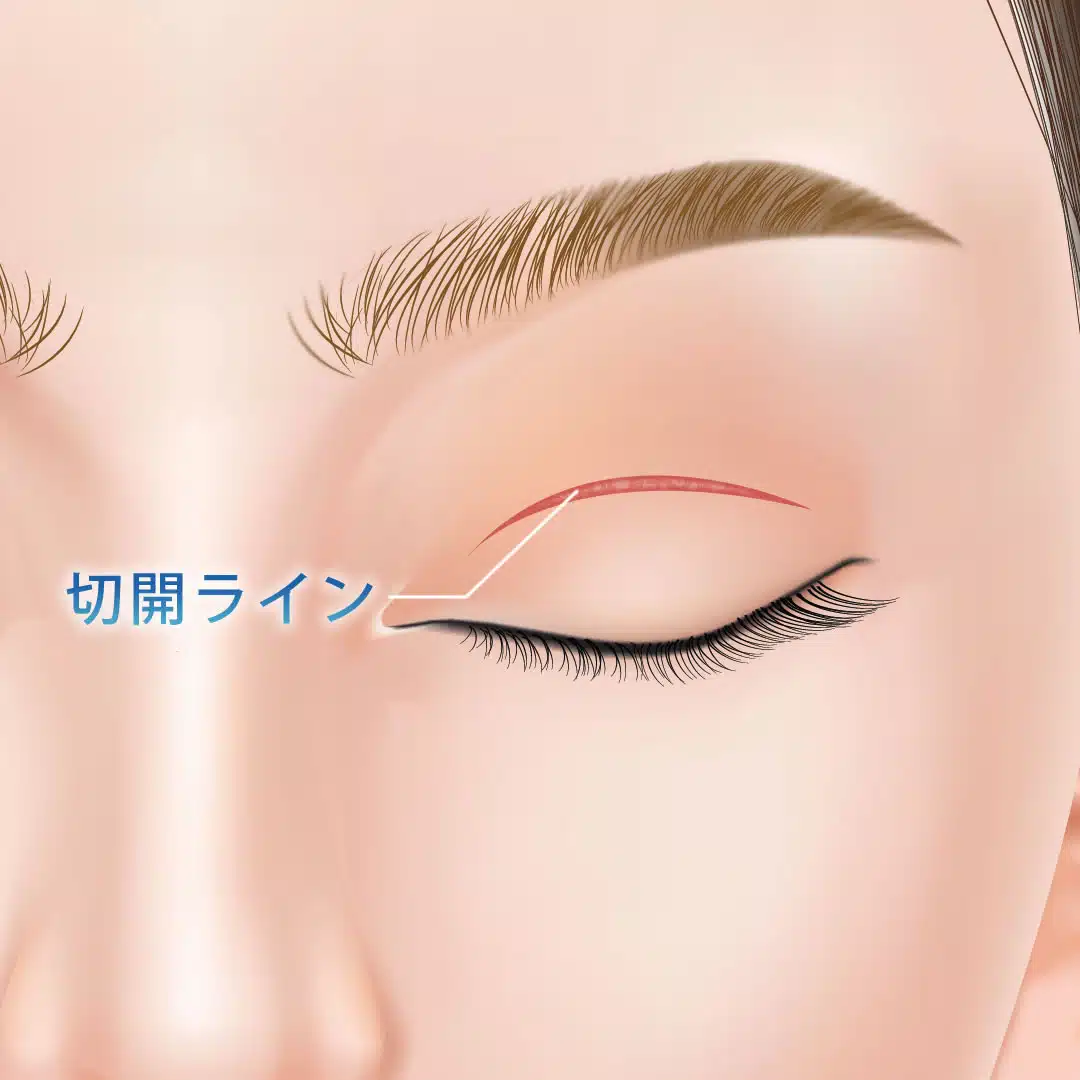 二重全切開　那覇