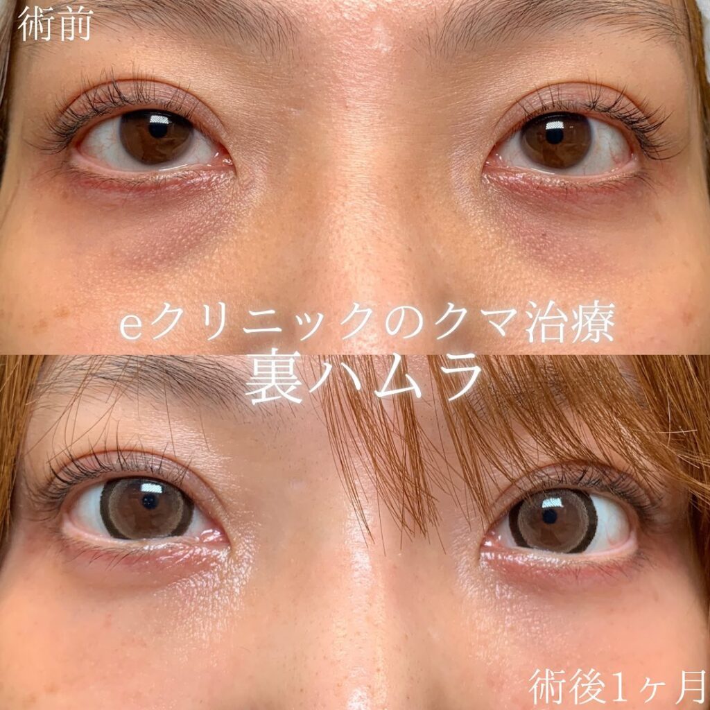 eクリニック那覇院の裏ハムラの症例画像(1)