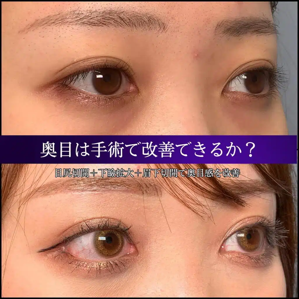 目尻切開 下瞼拡大 眉下切開 那覇