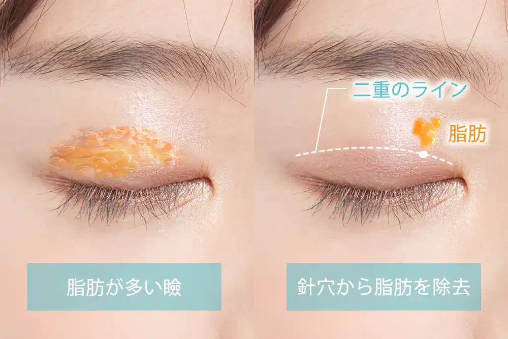 まぶたの脂肪取り 那覇
