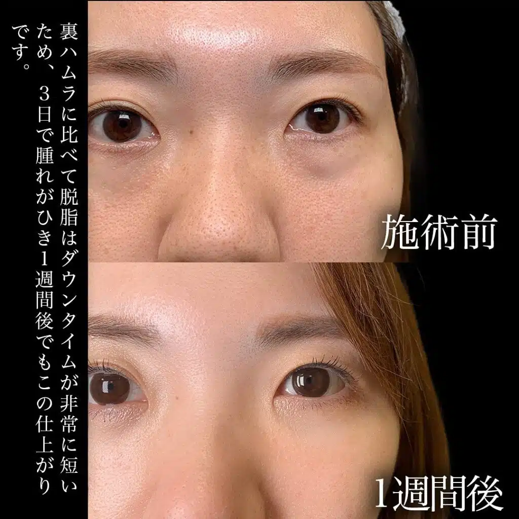 経結膜脱脂 那覇