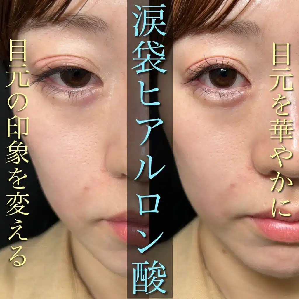 涙袋ヒアルロン酸 那覇
