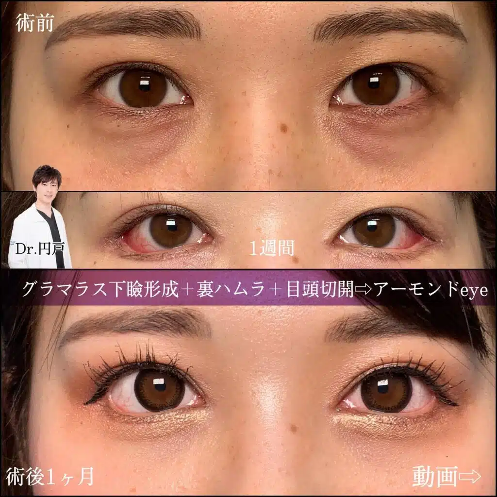 グラマラス下瞼形成 裏ハムラ 目頭切開 那覇