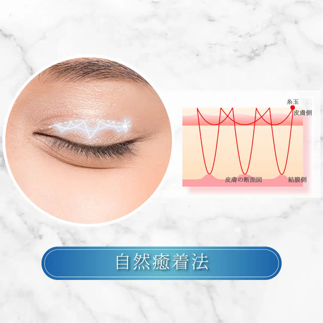 自然癒着法　那覇
