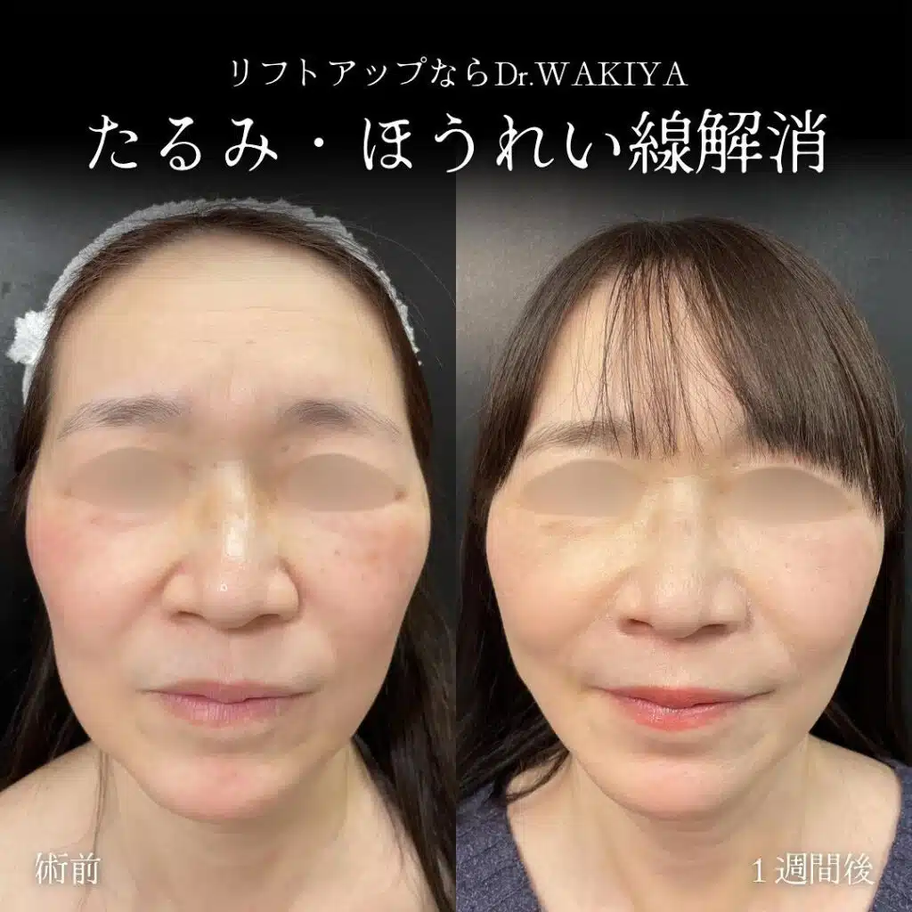たるみ・ほうれい線解消 那覇