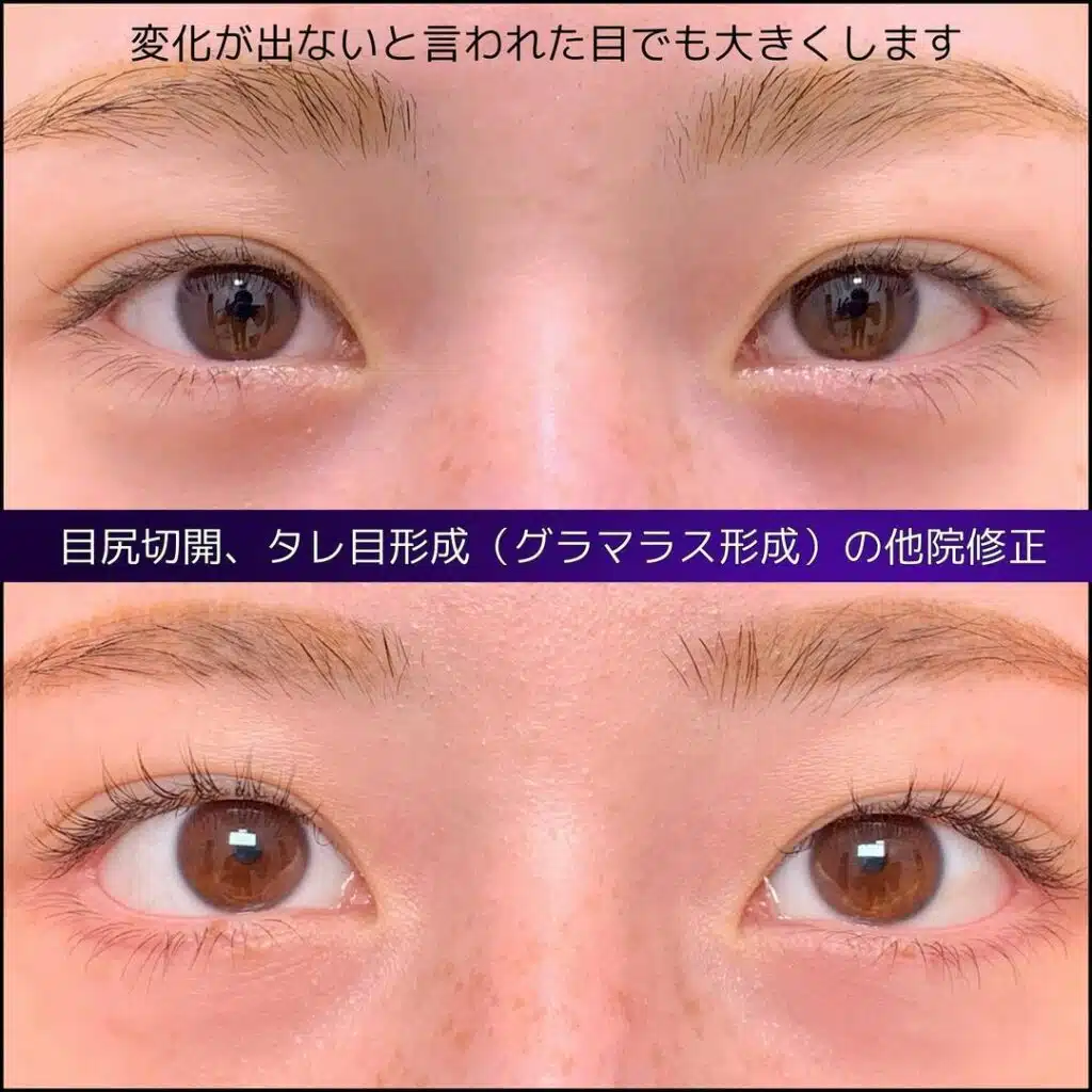 目尻切開 タレ目形成(グラマラス形成) 那覇