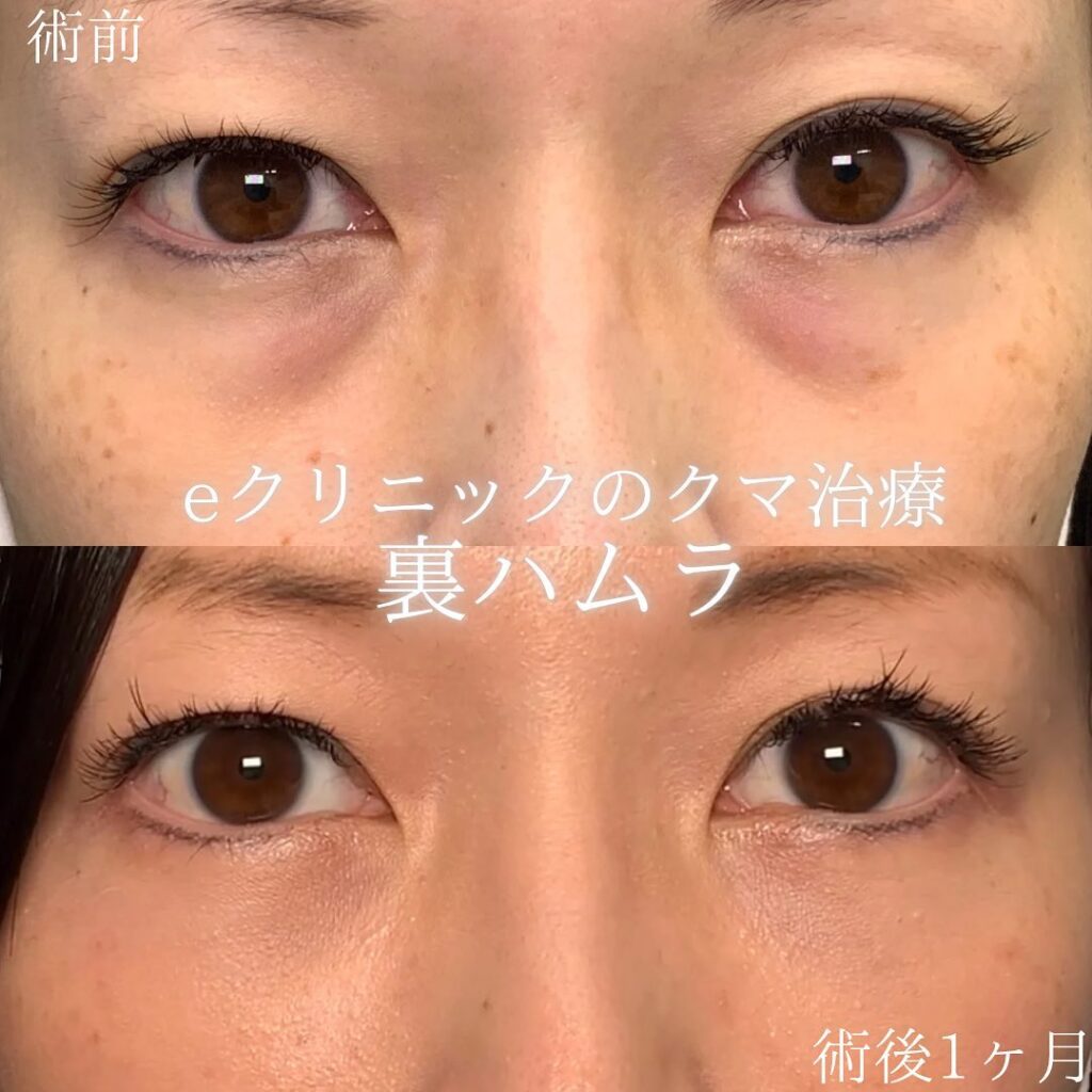 eクリニック那覇院の裏ハムラの症例画像(3)