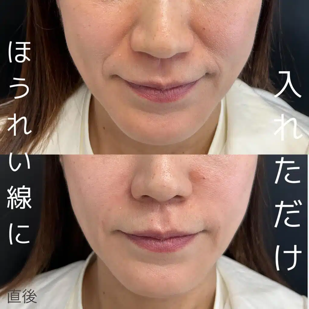 ほうれい線に入れただけ 那覇