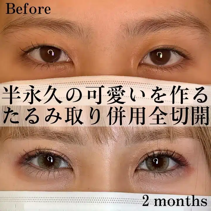 たるみ取り併用全切開 那覇