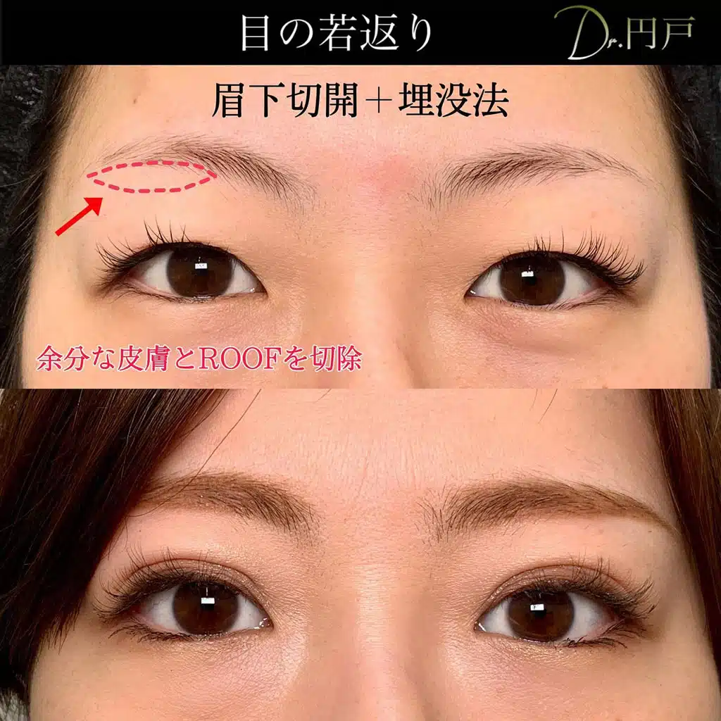 眉下切開 埋没法 那覇