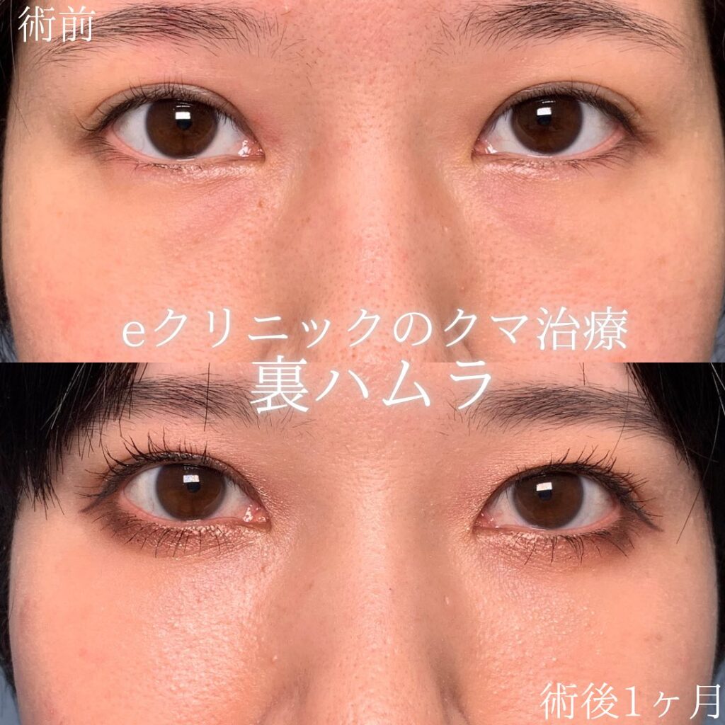 eクリニック那覇院の裏ハムラの症例画像(2)