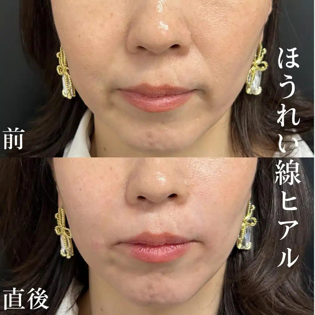 ほうれい線ヒアル 那覇