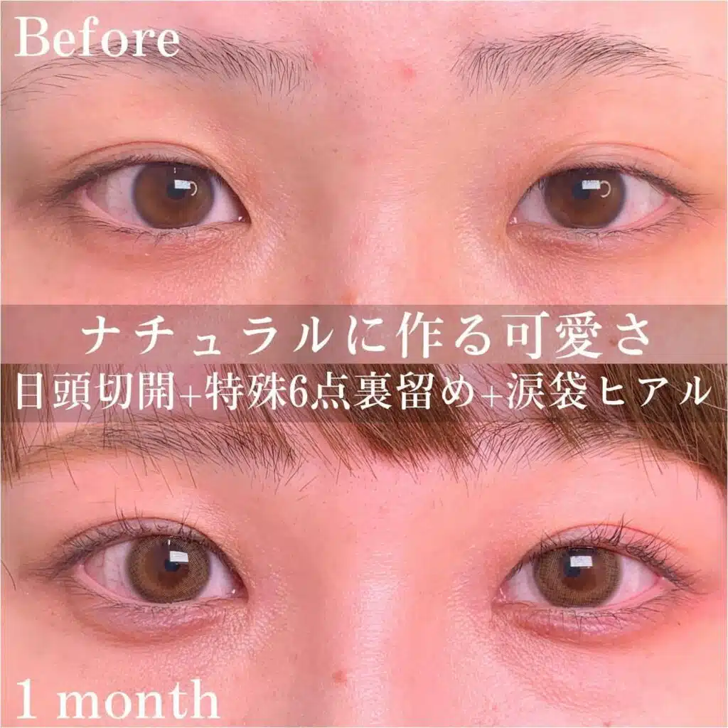 目頭切開 特殊6点裏留め 涙袋ヒアル 那覇