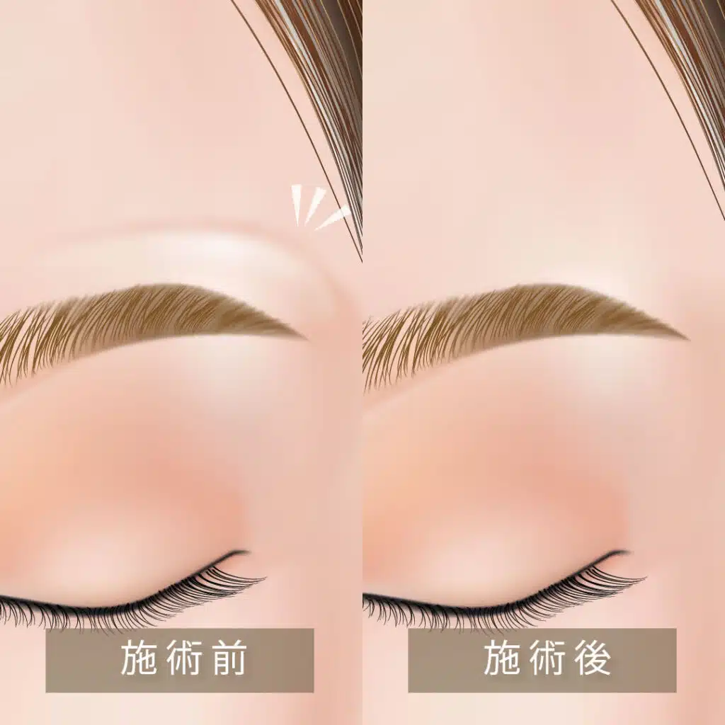 眉上ボトックス 那覇