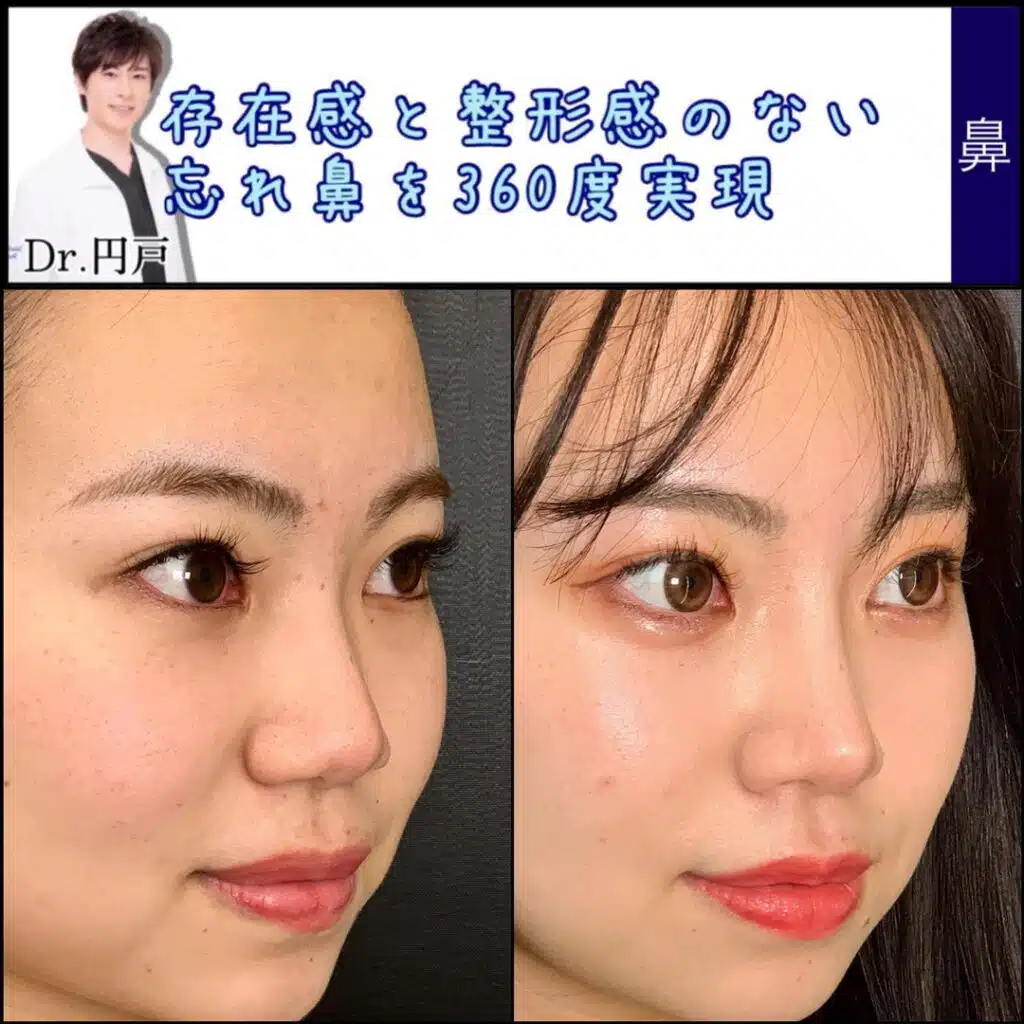 小鼻縮小 那覇