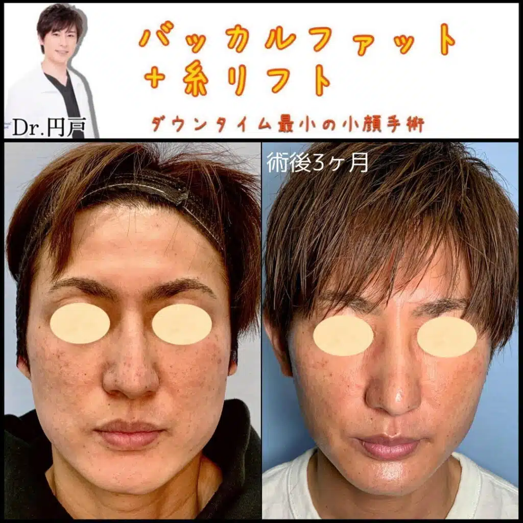 バッカルファット＋糸リフト　那覇