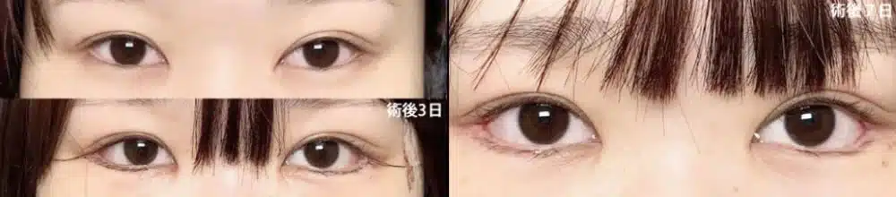 白目の露出を広げるデザイン　那覇