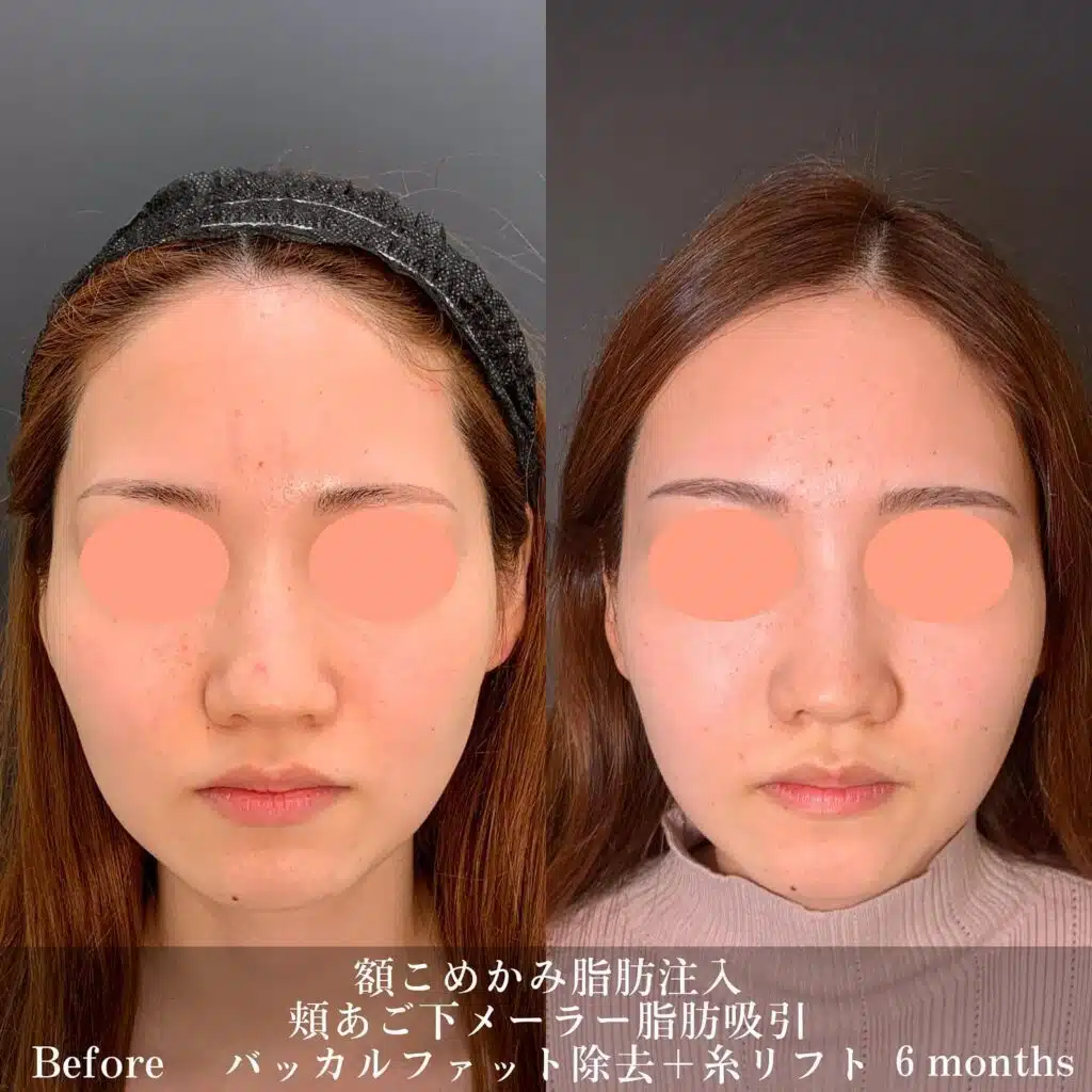額こめかみ脂肪注入　頬あご下メーラー脂肪吸引　バッカルファット除去＋糸リフト　那覇
