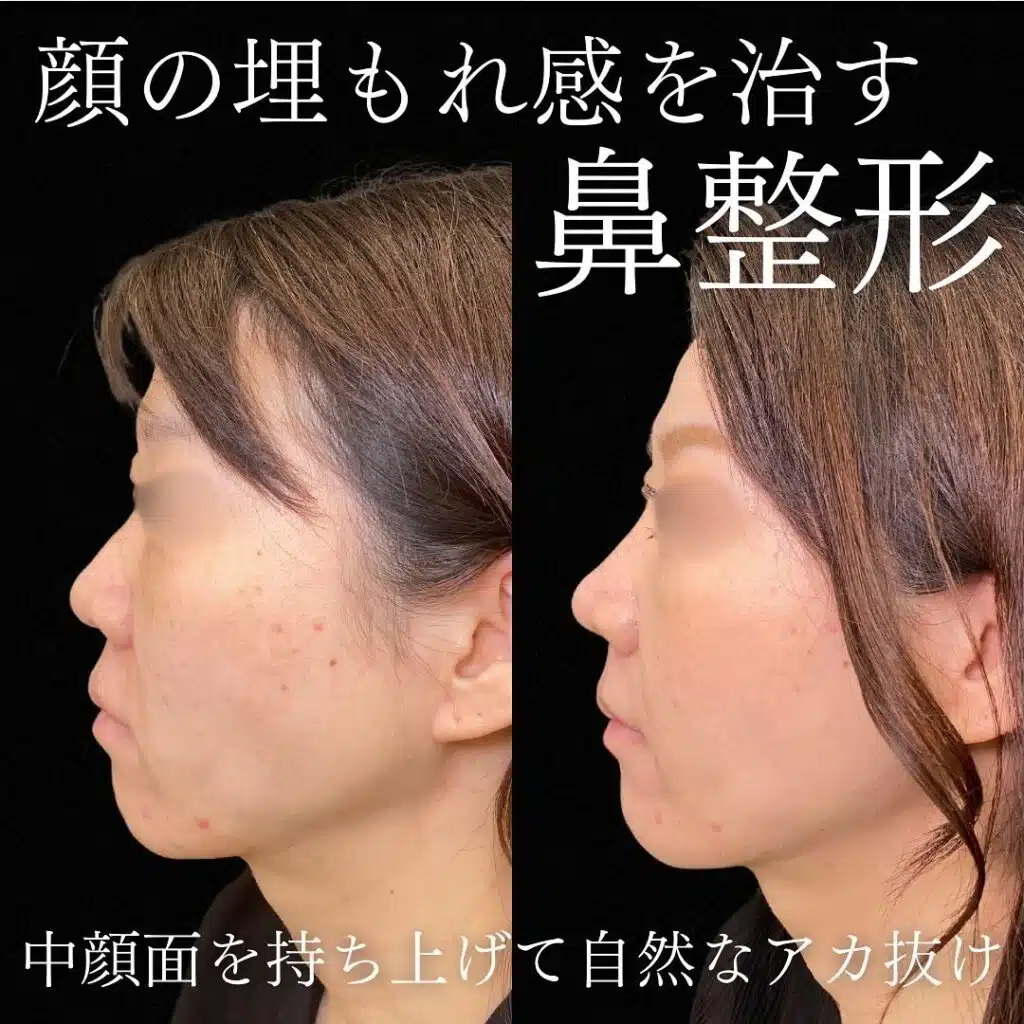 鼻尖形成 那覇