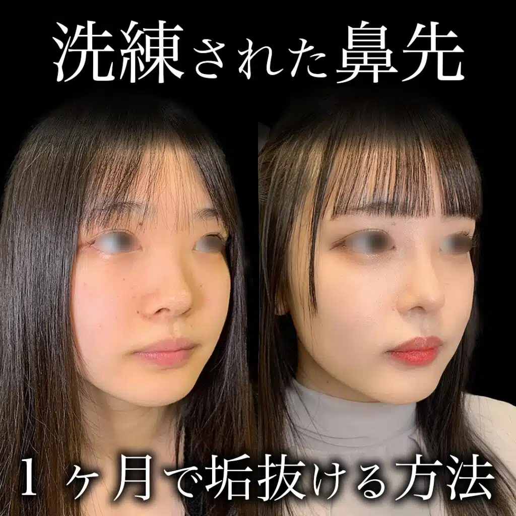 隆鼻術（鼻プロテーゼ）　那覇
