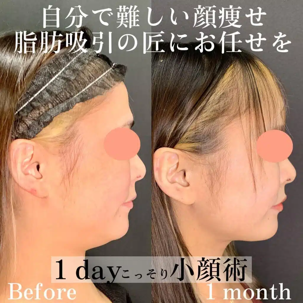 小顔脂肪吸引　那覇