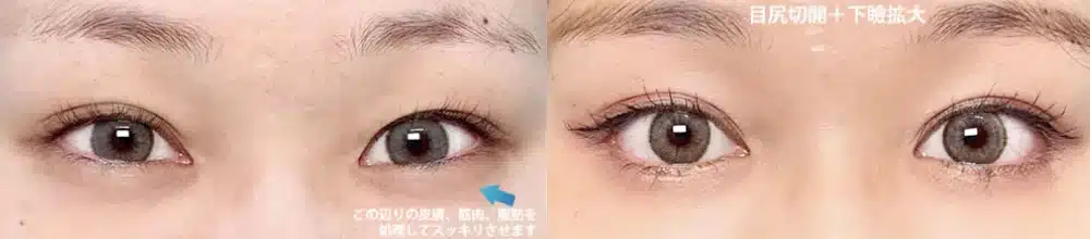 つり⽬を⾃然なアーモンド型に整えるデザイン　那覇