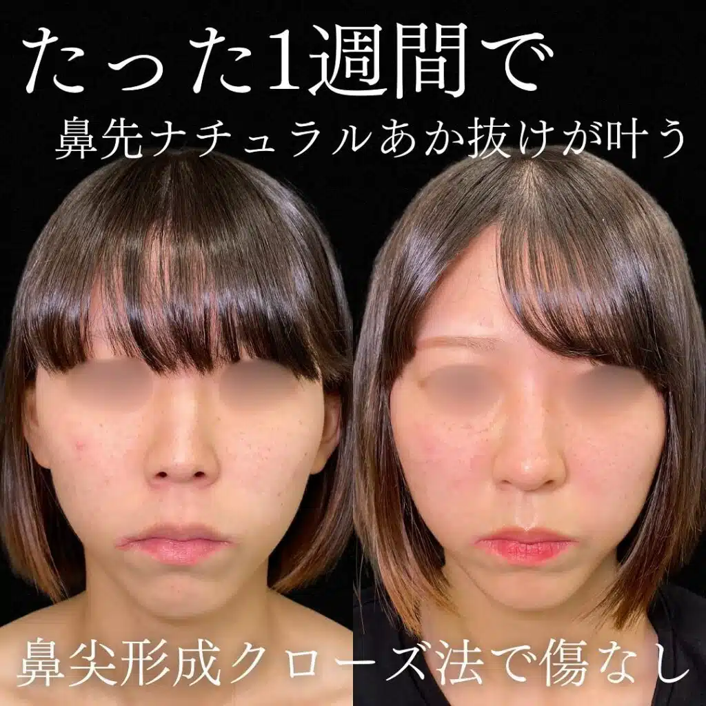 鼻尖形成クローズ法　那覇