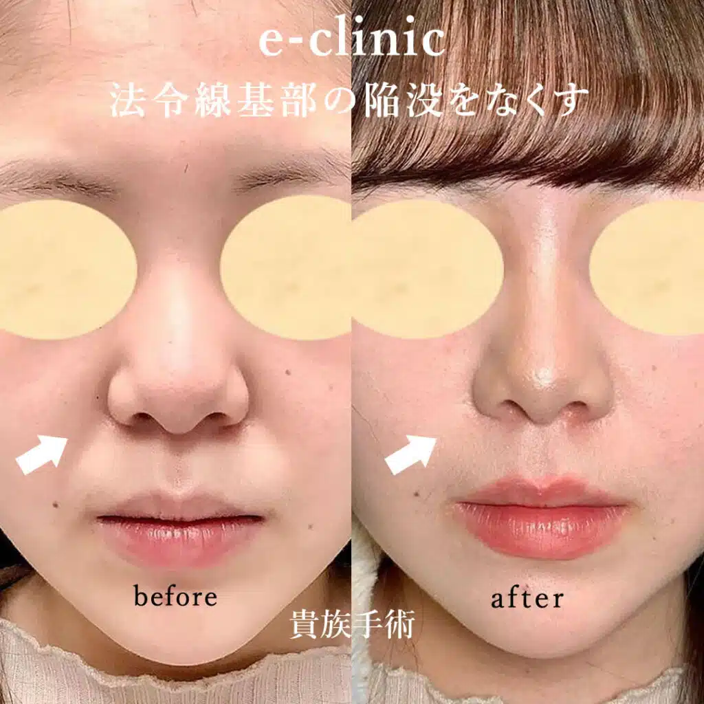 貴族手術 那覇