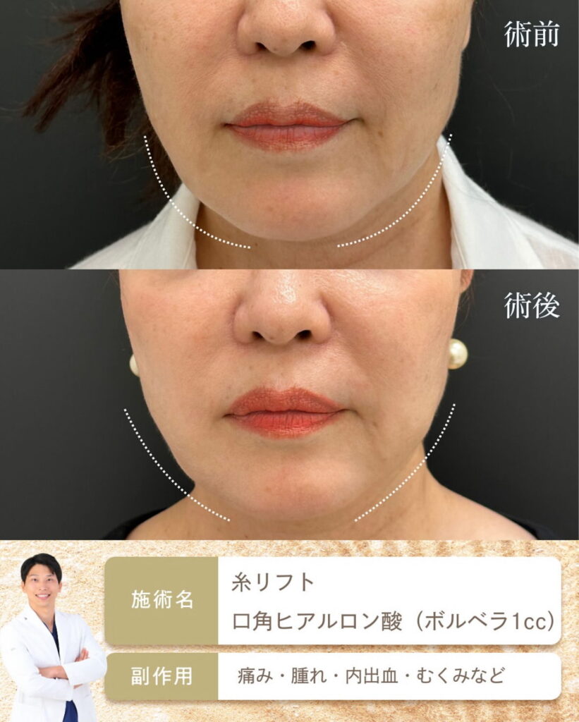 糸リフトとヒアルロン酸の山本医師の症例写真 (4)