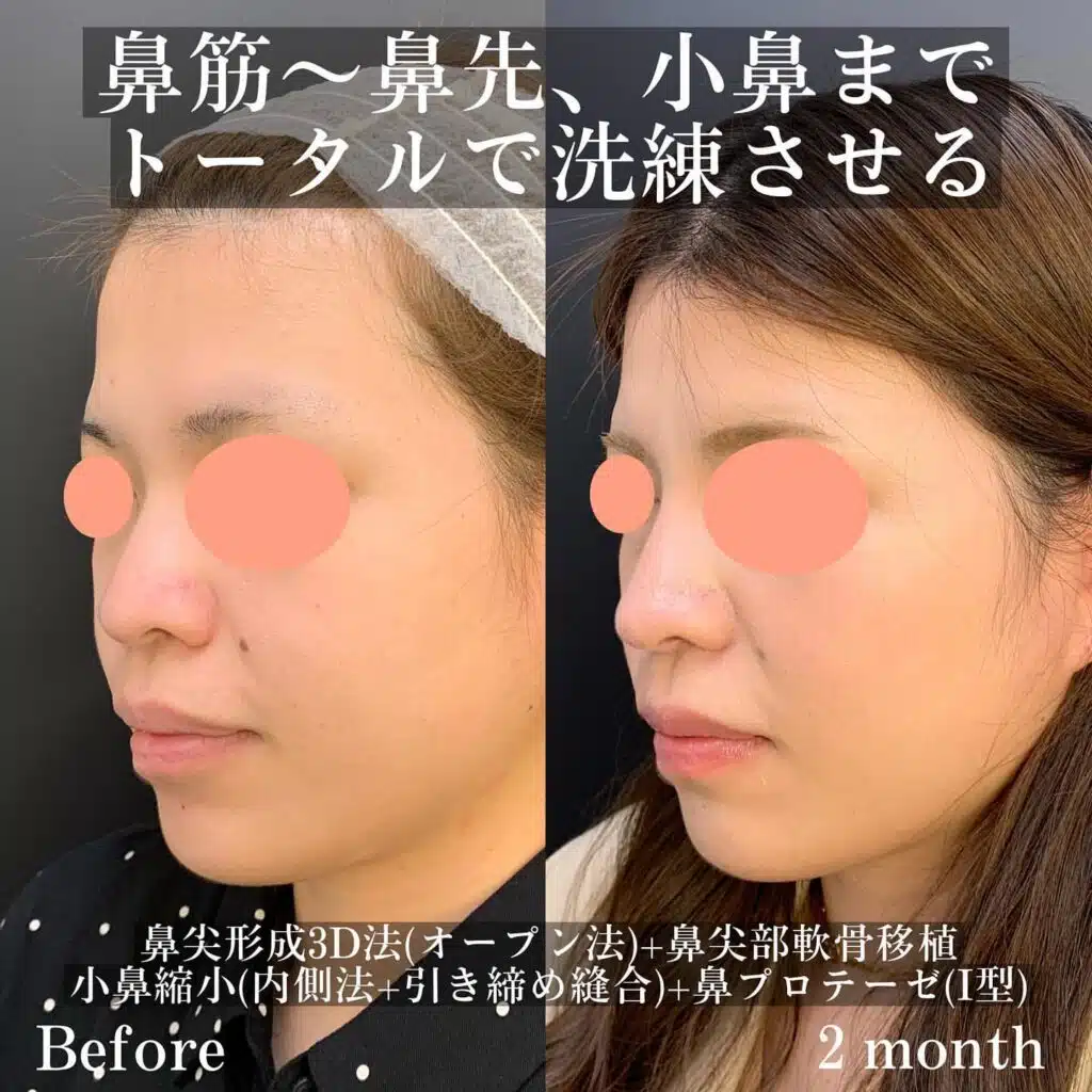 鼻尖形成3D法（オープン法）+鼻尖部軟骨移植+小鼻縮小（内側法+引き締め縫合）+鼻プロテーゼ（Ⅰ型）　那覇
