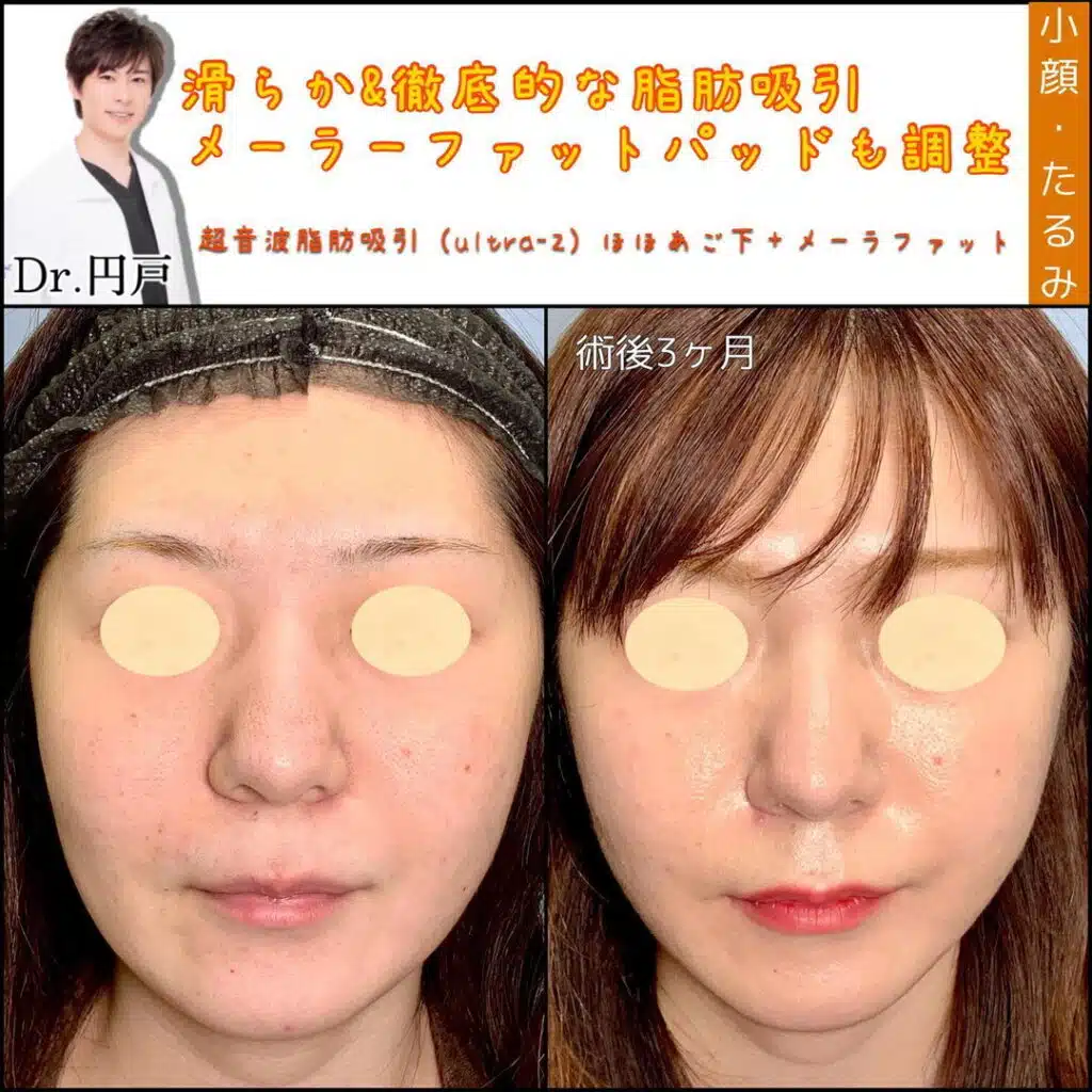 超音波脂肪吸引ほほあご下＋メーラーファット　那覇