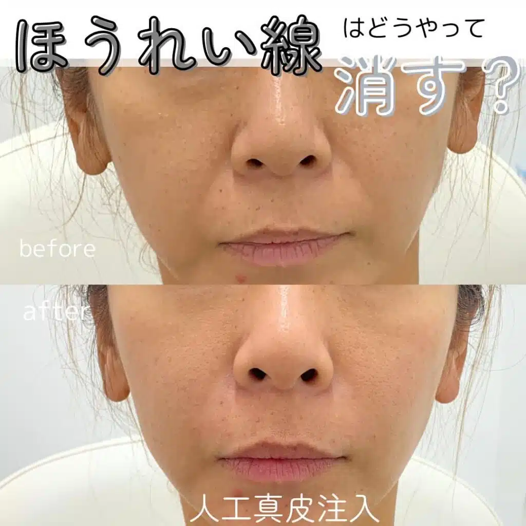 人工真皮注入 那覇