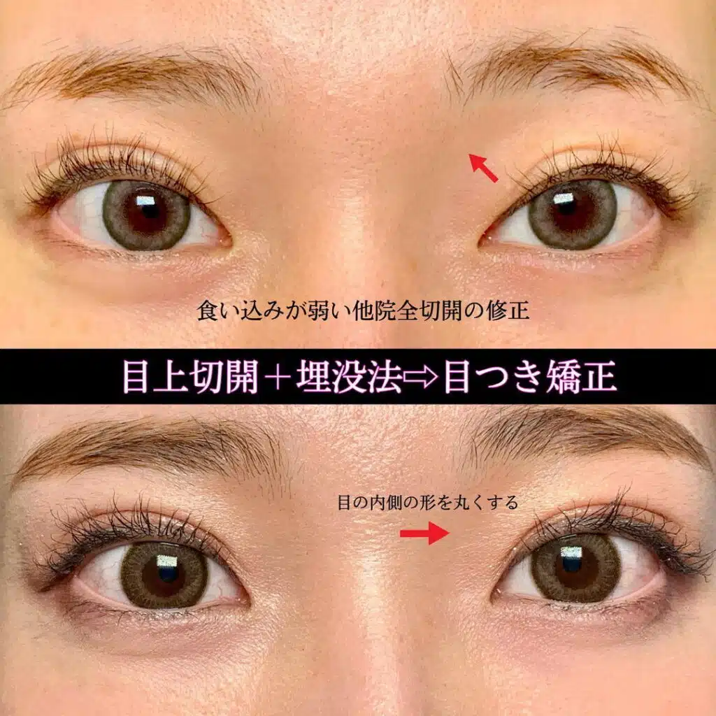 目上切開+埋没法　那覇