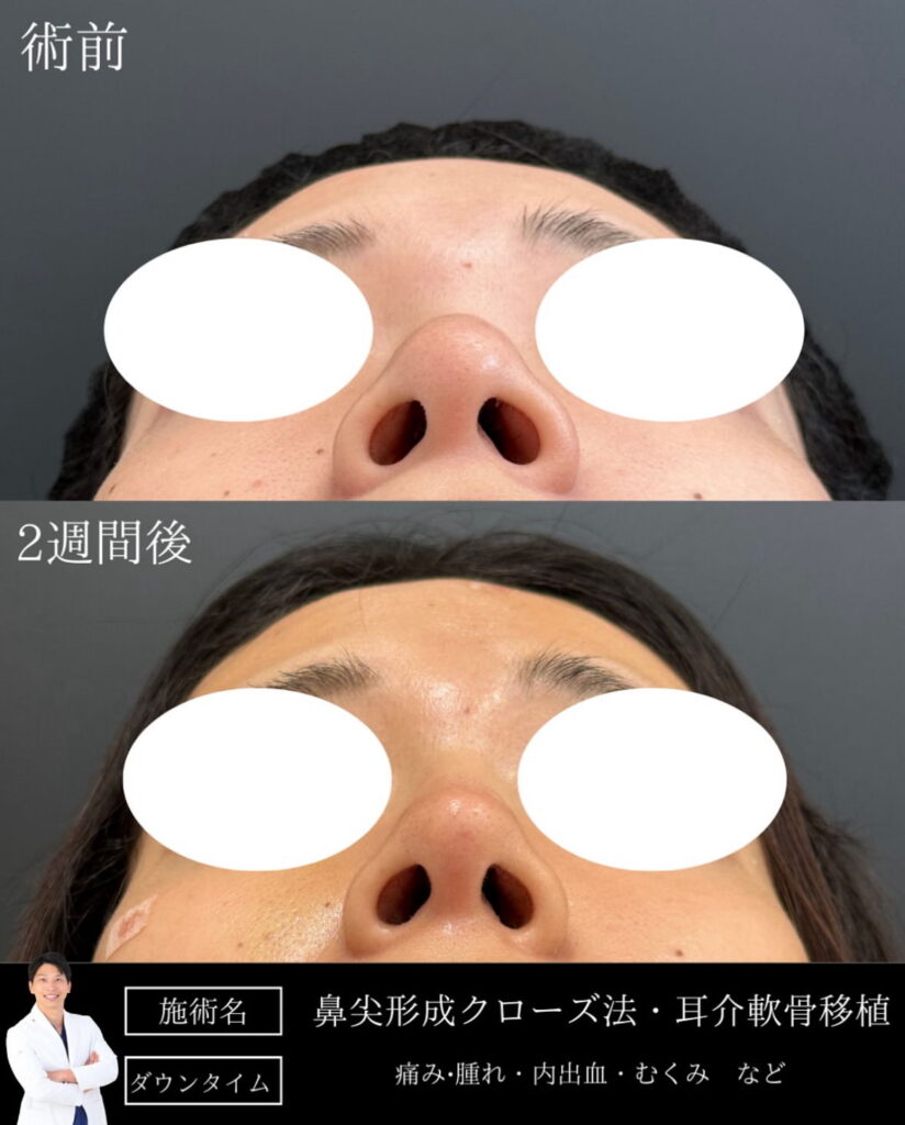 鼻尖形成クローズ法と耳介軟骨移植の山本医師の症例写真 (1)