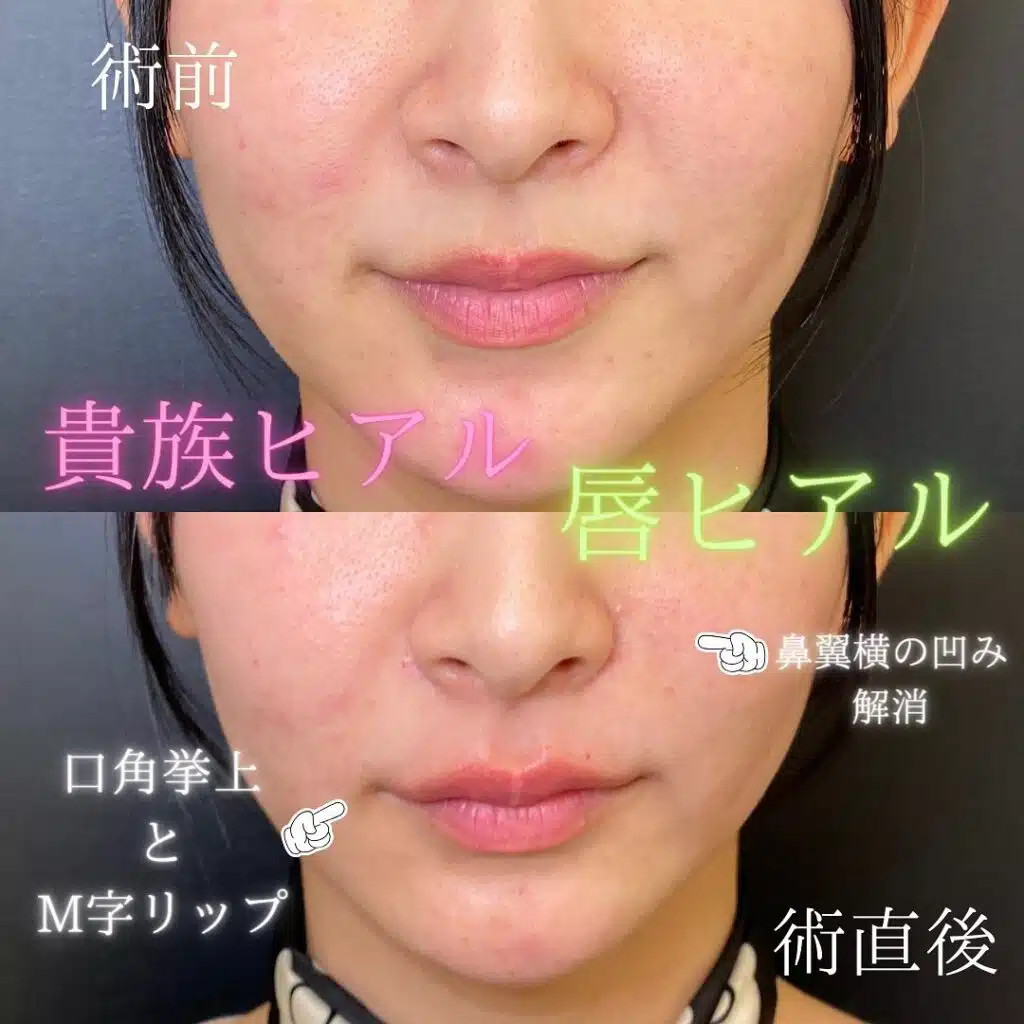 貴族ヒアルロン酸 那覇