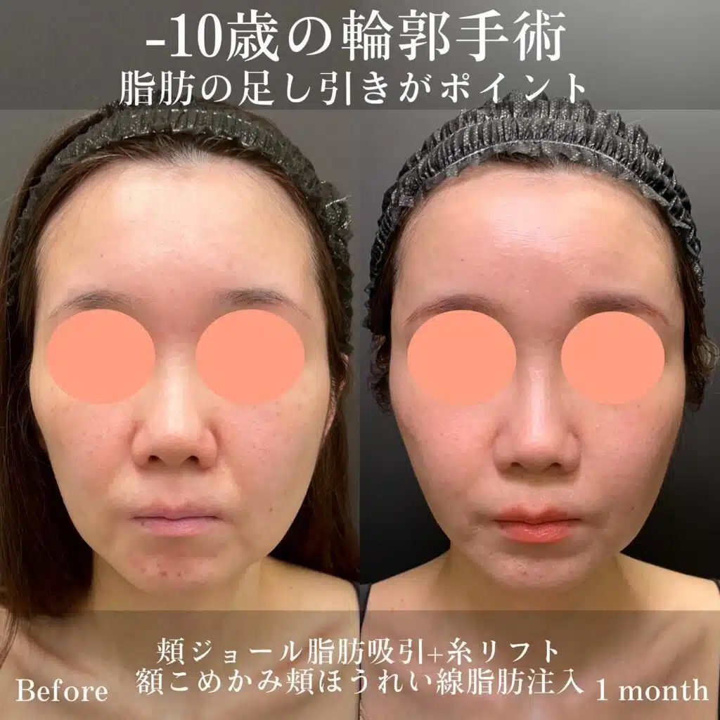 頬ジョール脂肪吸引+糸リフト　額こめかみ頬ほうれい線脂肪注入　那覇