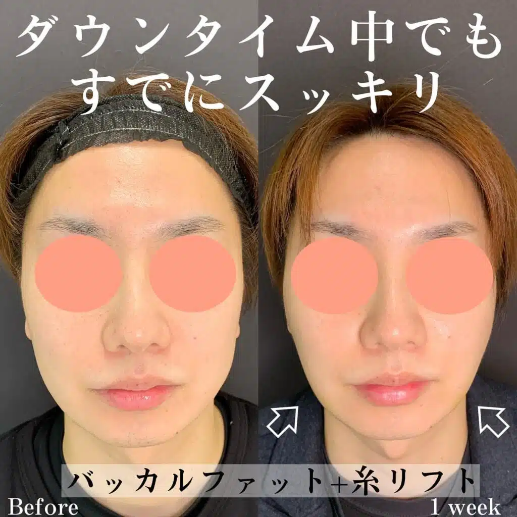 バッカルファット＋糸リフト　那覇