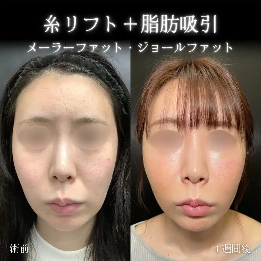 糸リフト＋脂肪吸引　那覇