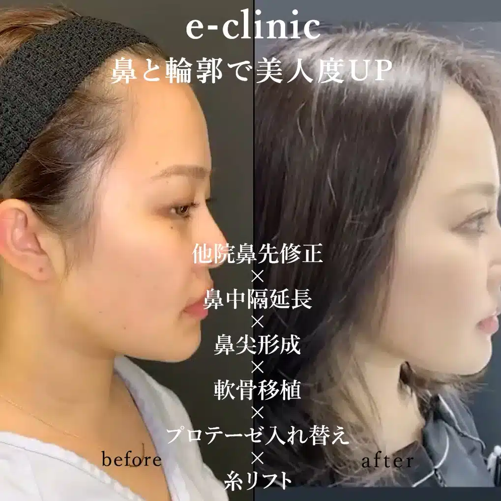 他院鼻先修正×鼻中隔延長×鼻尖形成×軟骨移植×プロテーゼ入れ替え×糸リフト　那覇
