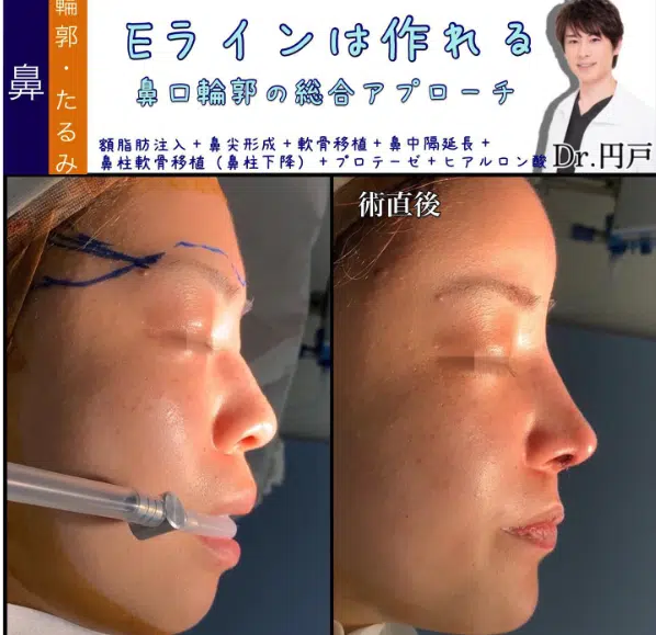 額脂肪注入+鼻尖形成+軟骨移植+鼻中隔延長+鼻柱軟骨移植(鼻柱下降)+プロテーゼ+ヒアルロン酸 那覇