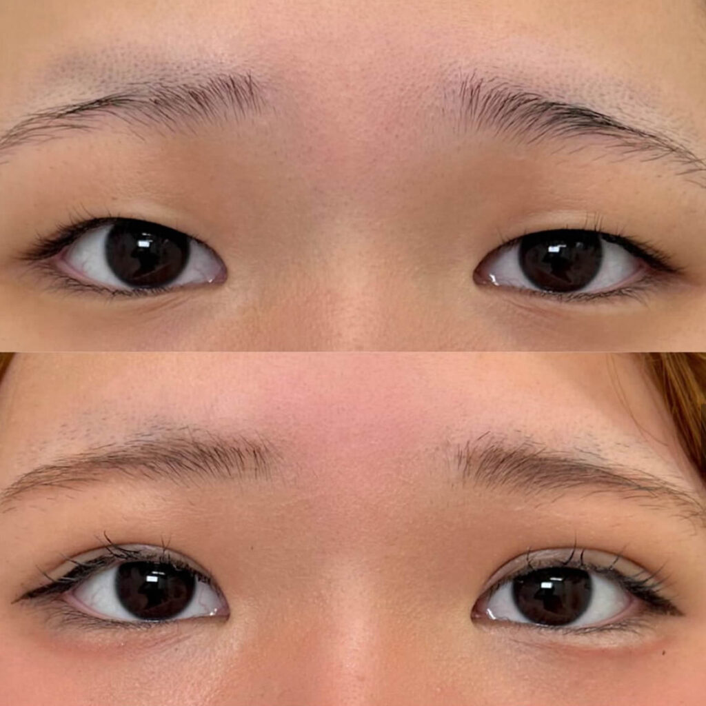 埋没法の山本院長の症例写真