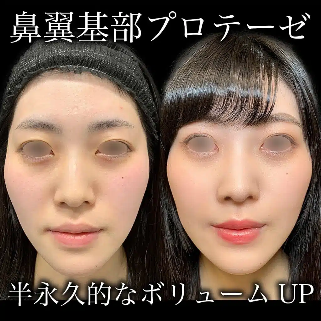 鼻翼基部プロテーゼ 那覇