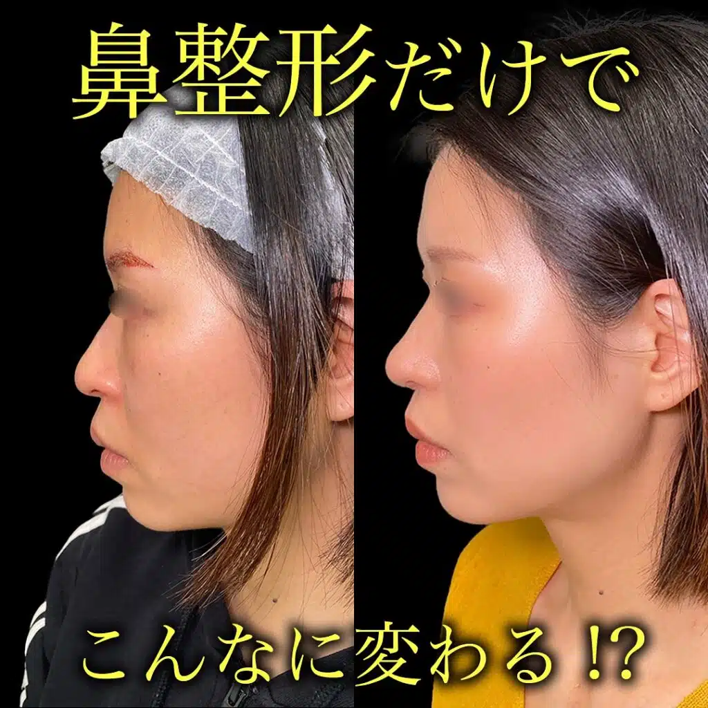 鼻尖形成と耳介軟骨移植と小鼻縮小　那覇