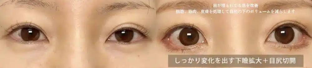 しっかり変化を出す下瞼拡大＋目尻切開　那覇