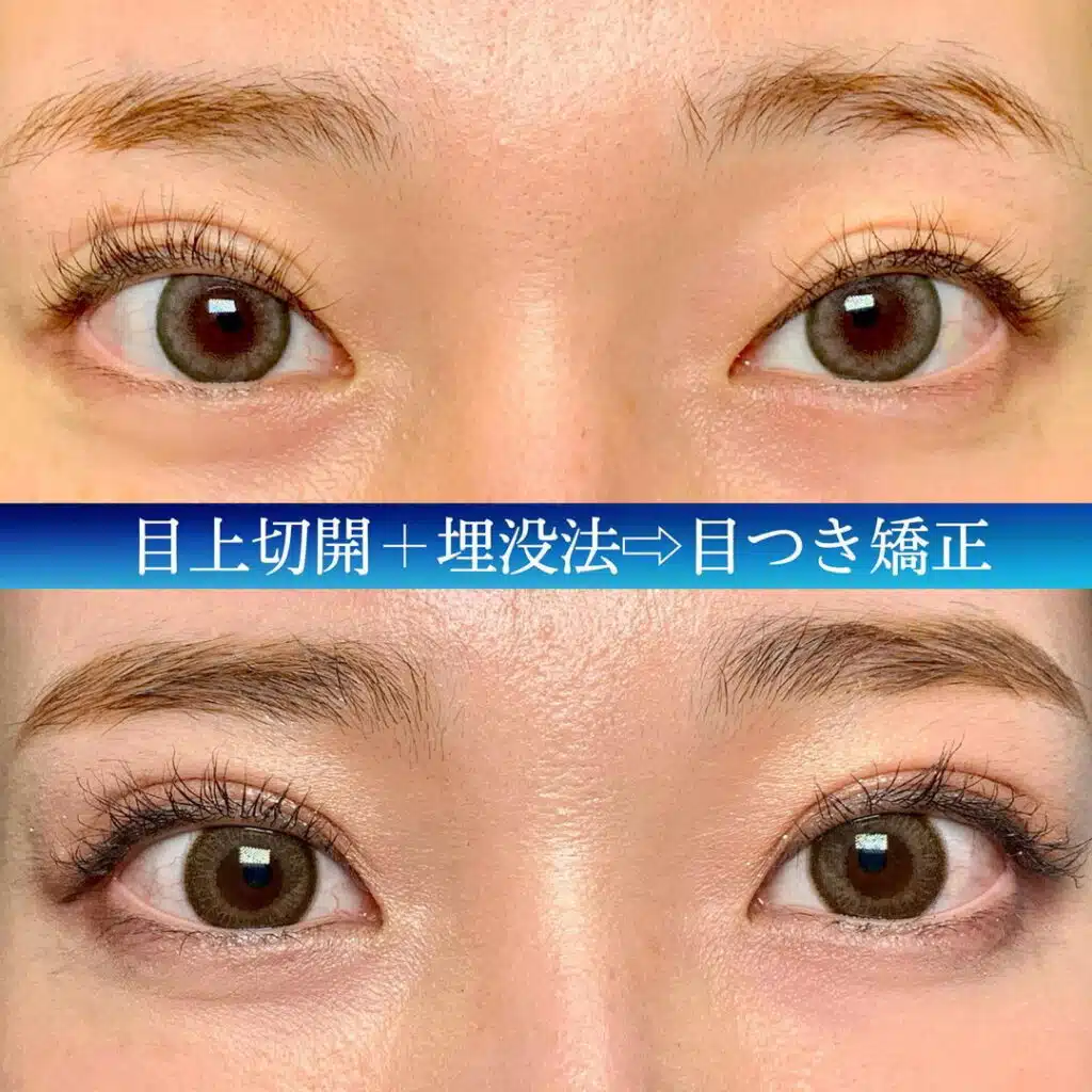 目上切開+埋没法　那覇